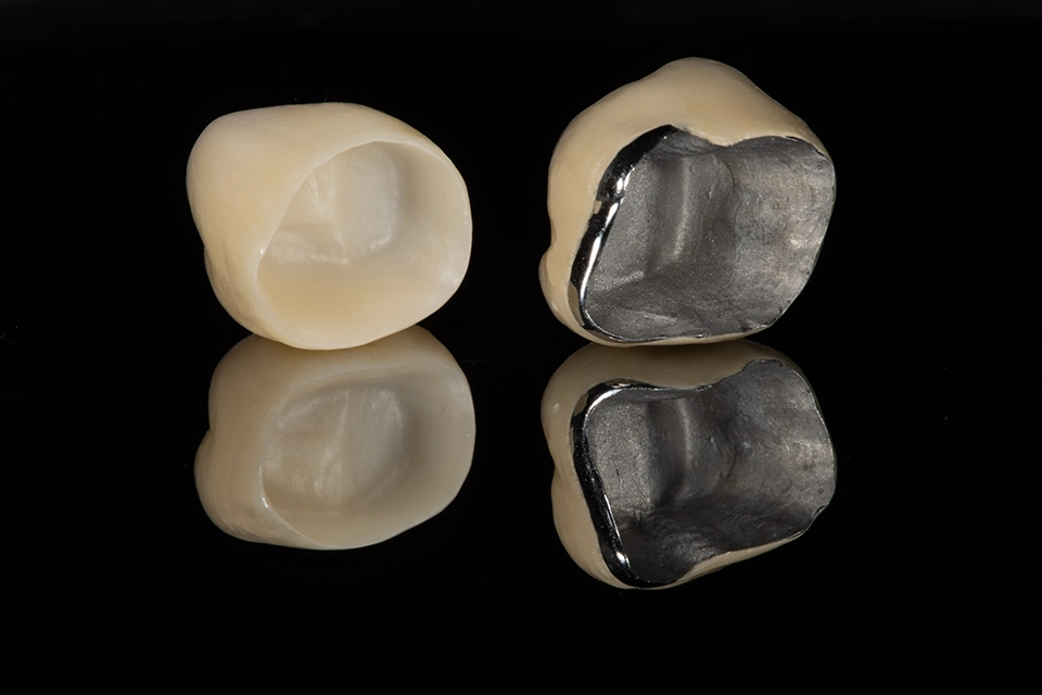 Porcelain-fused-to-metal (PFM) crowns
روکش متال سرامیک