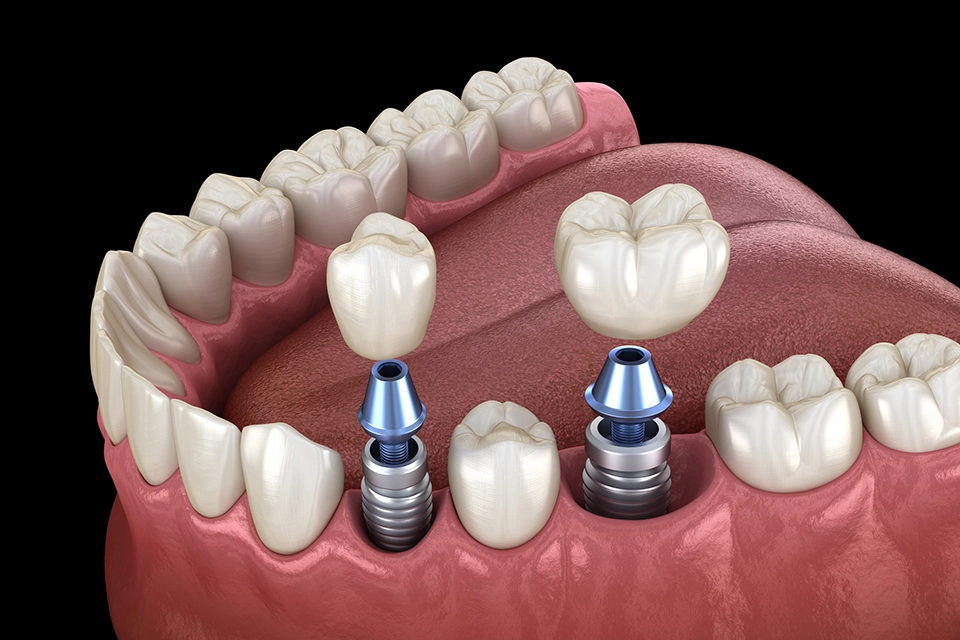 Fabrication and Installation of Crowns for Dental Implants