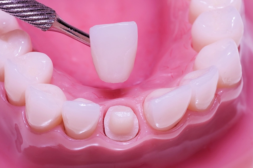 pure ceramic crowns