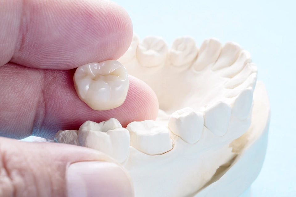 Dental Crown روکش دندان