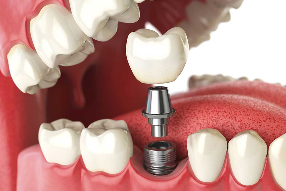 endosteal dental implants