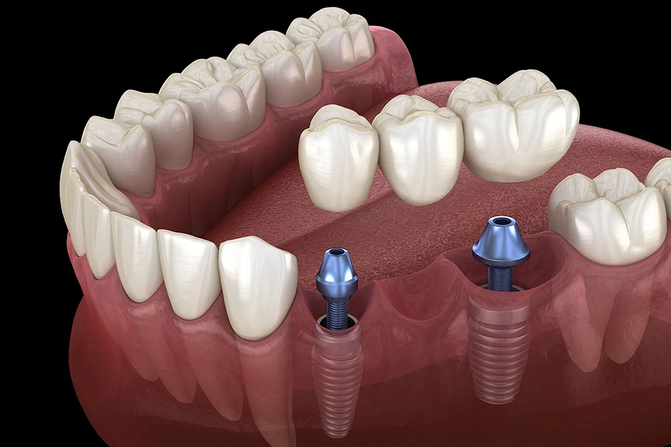 implant-supported bridge