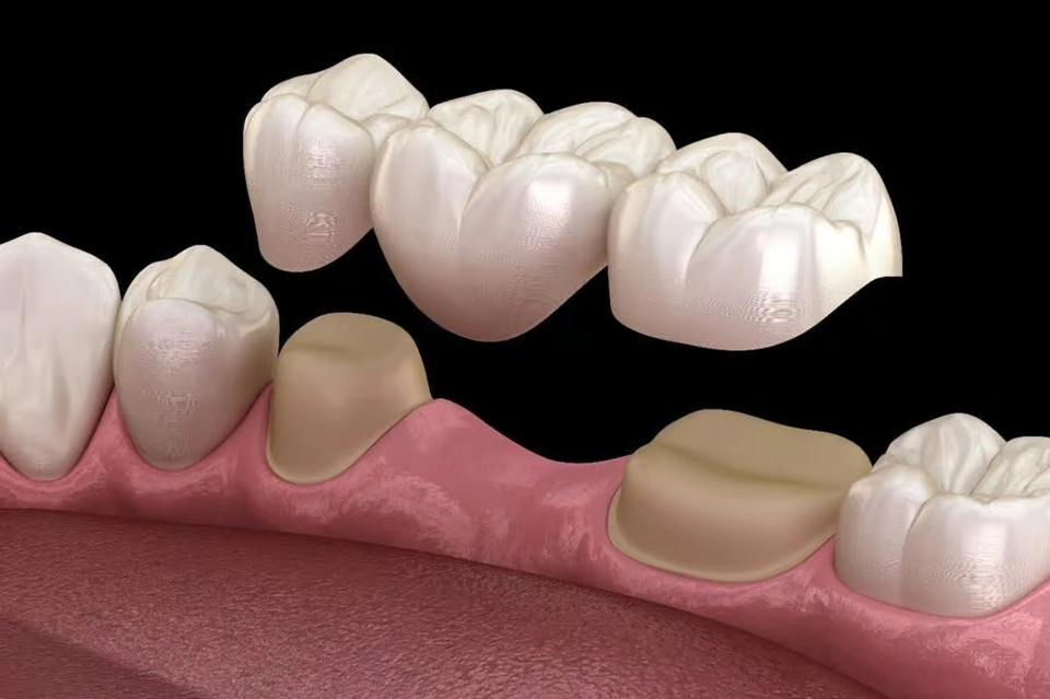 Simple Dental Bridgeبریج دندانی سنتی