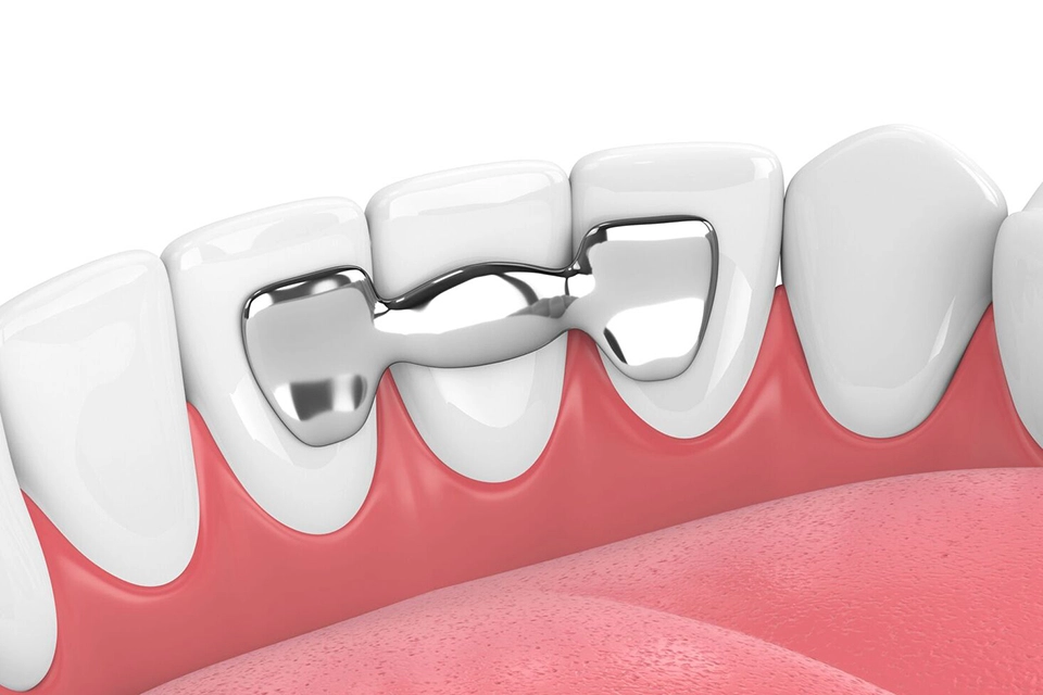 Maryland dental bridge