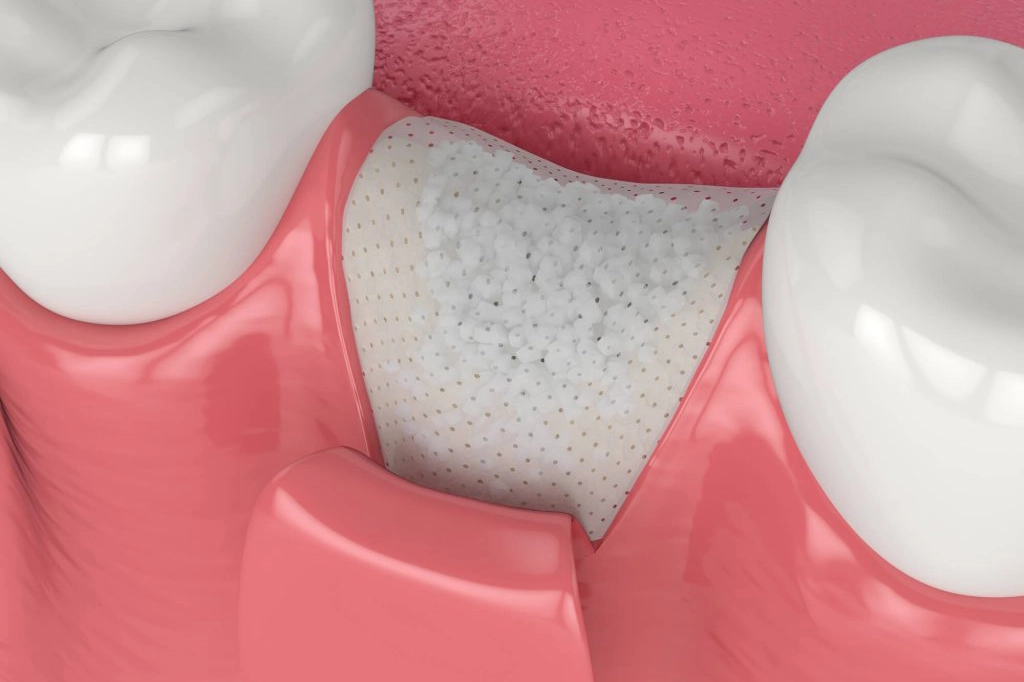 Gum Bone Grafting پیوند استخوان لثه برای ایمپلنت