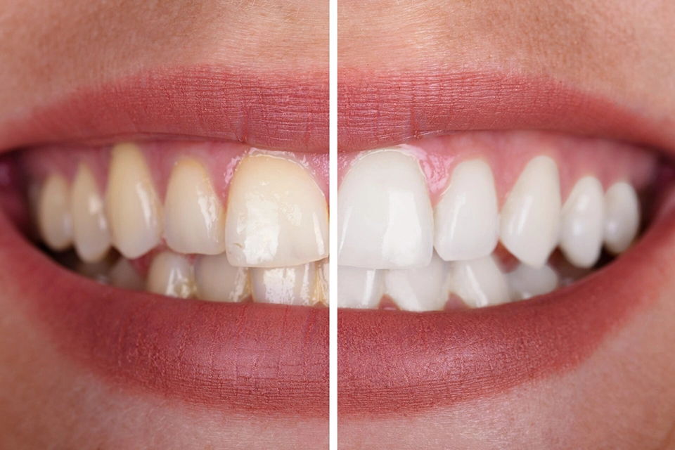 Teeth whitening