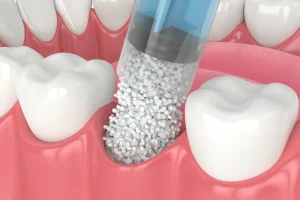 Gum Bone Grafting