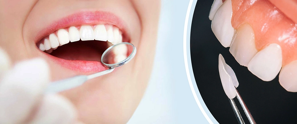 dental laminates and veneers