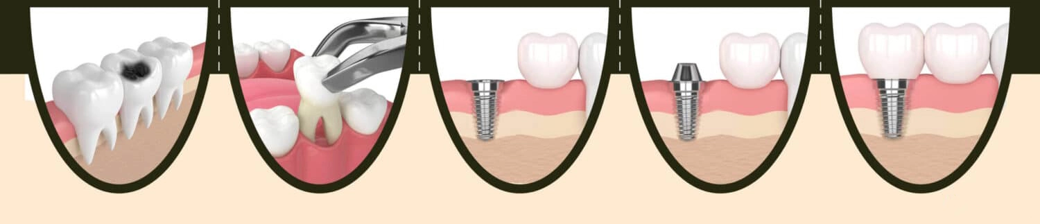 Steps of Dental Implant Placement: A Complete Guide